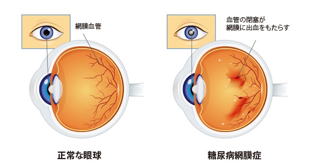非増殖性糖尿病性網膜症の症状