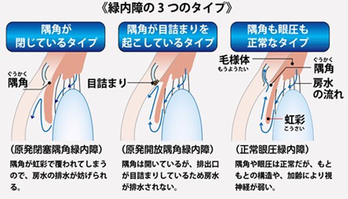 開放隅角緑内障の症状