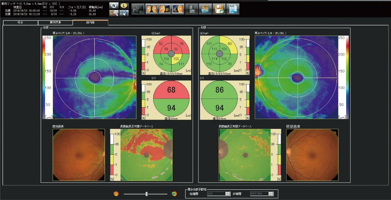 光干渉断層計（OCT）による眼底写真の解析